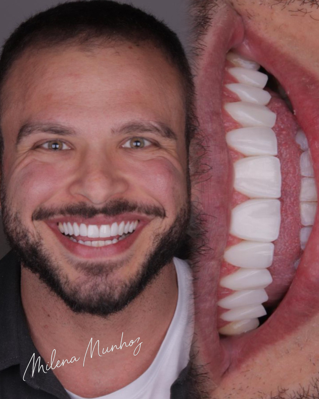 Antes e depois: sorriso renovado com lentes em resina pela Dra. Milena Munhoz